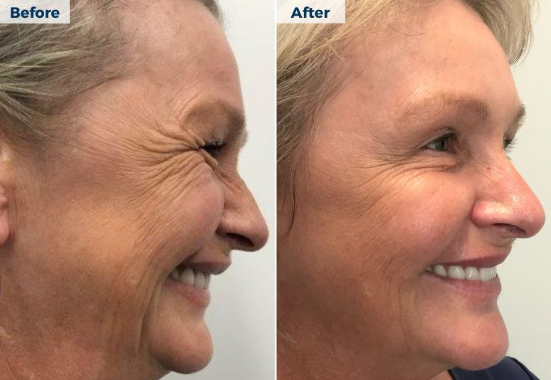 NanoNeedling National Skin Cancer Centres